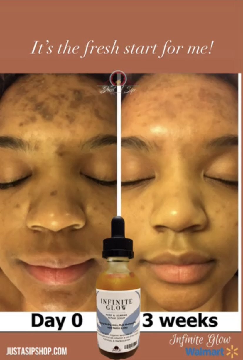 Infinite Glow Acne & Scarring Repair Serum